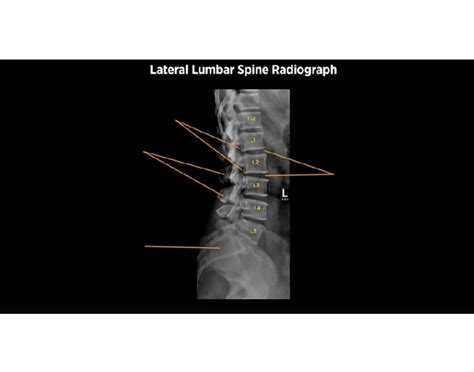 Lateral Lumbar Spine X-ray Anatomy Quiz