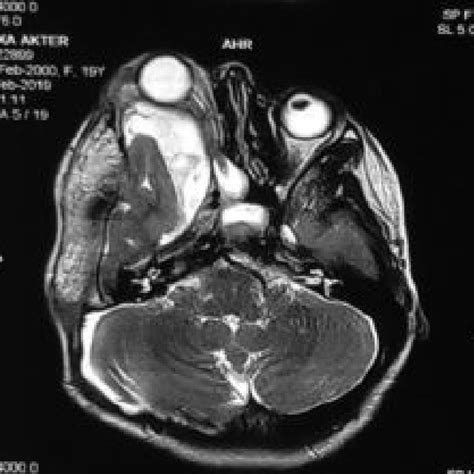 Axial CT scan of brain showing Right orbital proptosis, Retro-orbital... | Download Scientific ...