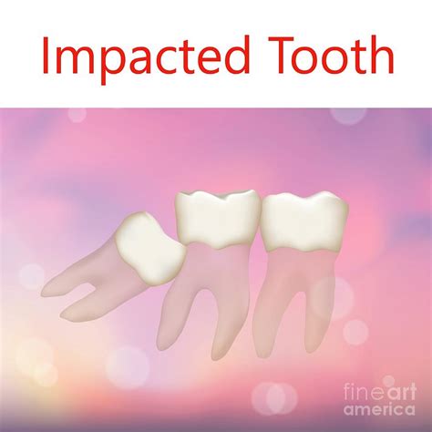 Impacted Tooth Photograph By Veronika Zakharovascience Photo Library