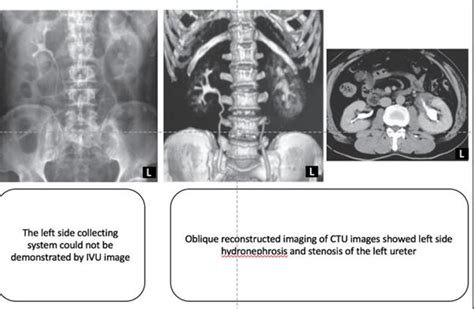 Table 1 From Role Of Conventional IVU Intra Venous Urography And