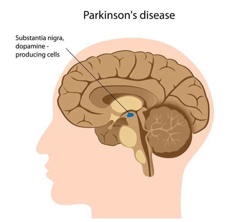 An Overview Of Parkinsons Disease Affecting The Body El Paso Tx