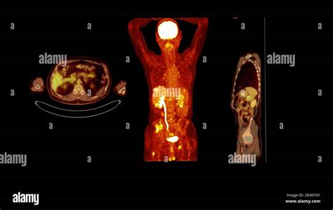 Imagen Pet Ct De Todo El Cuerpo Humano Plano Axial Coronal Y Sagital