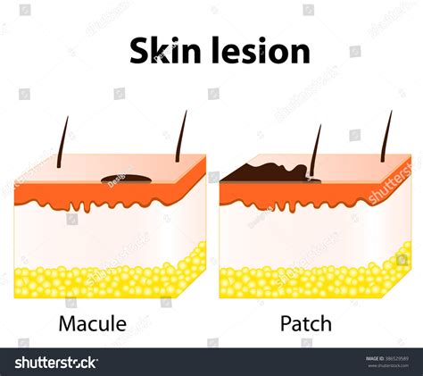 Patch Skin Lesion Images Stock Photos Vectors Shutterstock