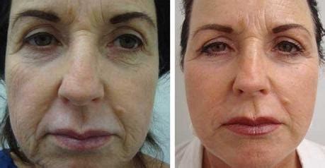 Stem Cell Facelift-The New Age Facelift - Paperblog