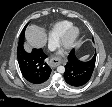 Esophageal Cancer Esophagus Case Studies Ctisus Ct Scanning