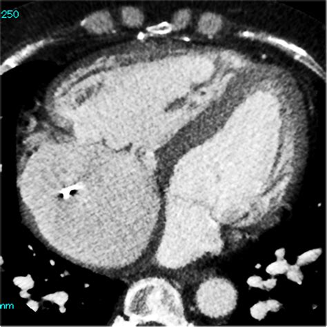 Axial View Of The Heart On Computed Tomography Scan The Right‐side Download Scientific Diagram