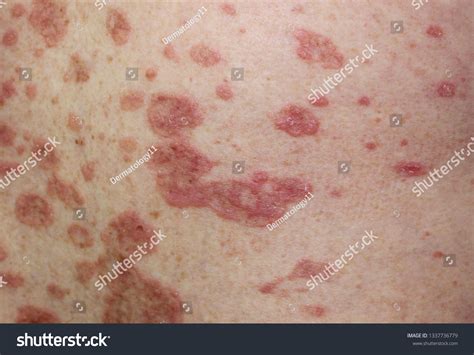 Annular Lichen Planus