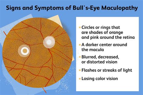 Bull S Eye Maculopathy Signs Causes Diagnosis And More