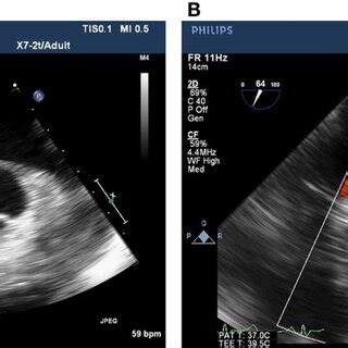 Two Dimensional Echocardiogram Short Axis View Of The Aortic Valve