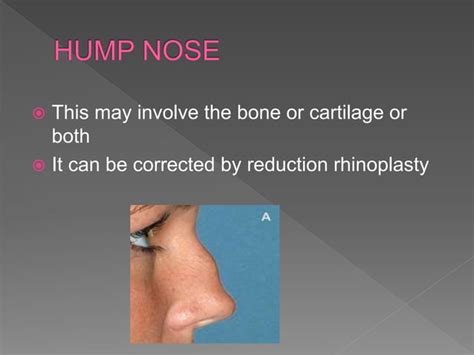 Diseases Of External Nose Ppt