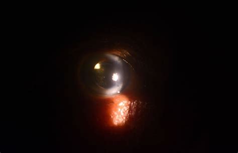 Flashing Lights In Eye After Cataract Surgery Shelly Lighting