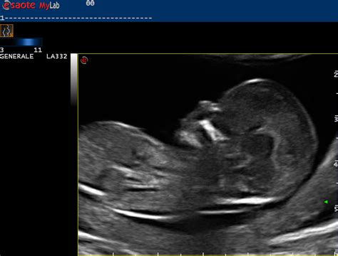 High Performance And Precision Ultrasound In Obstetric Imaging Esaote