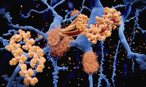 Tau protein disrupts molecular transport in neurons in Alzheimer's