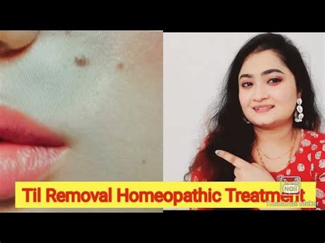 Mole Removal Homeopathic Medicine Black Mole Removal Medicine In