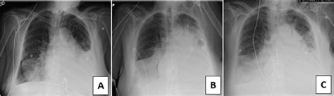 Pneumothorax Vs Atelectasis X Ray Holli Latrina