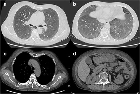 Diffuse Parenchymal Pulmonary Amyloidosis Associated With Multiple Myeloma A Case Report And