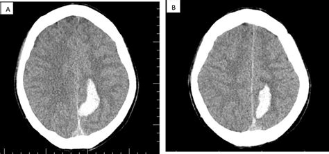 Isolated Inferior Sagittal Sinus Thrombosis Imcrj