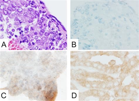 Utility Of The Braf Pv600e Immunoperoxidase Stain In Fna Direct Smears