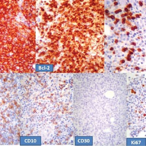 Neoplastic Cells Were Strongly Positive For Cd And Bcl Focally