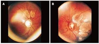 Aicardi syndrome, causes, examination and management - Ophthalmology ...