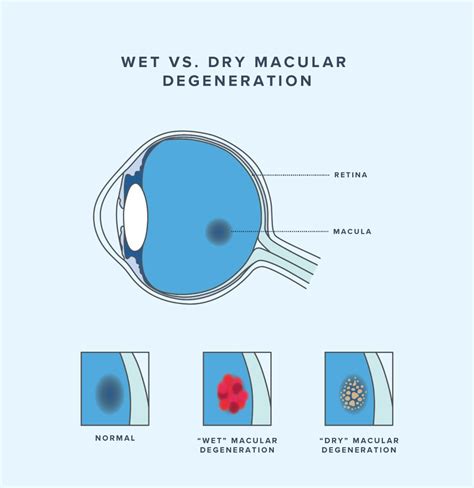 What Is Macular Degeneration Warby Parker