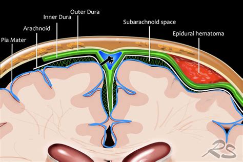 Intracranial Hematoma