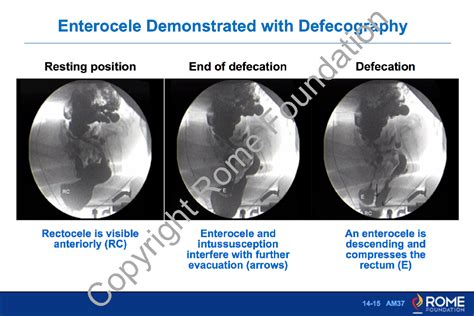 Anorectal 15 – Enterocele Demonstrated with Defecography – Rome Online