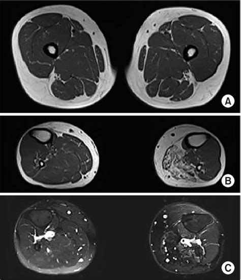 Axial Images Of Lower Extremity Mri A Axial T Weighted Image T