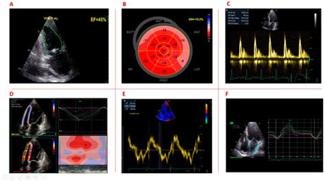 Jcm Free Full Text Echocardiographic Features Of Cardiac