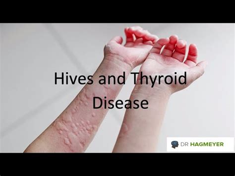 Consider These 5 Areas When It Comes To Treating Chronic Hives Dr Hagmeyer