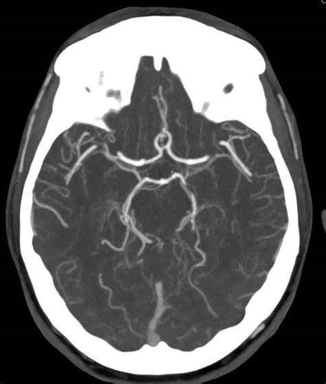 Head Ct Scan Ct Scan Circle Of Willis Scan Images