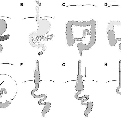 Secondary Reconstruction With An Ileo Right Hemi Colonic Cervical