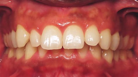 Class Ii Division 1 Malocclusion Excessive Overjet Deep Overbite Case Gallery