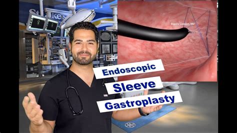 Endoscopic Sleeve Gastroplasty Esg Endosleeve Youtube