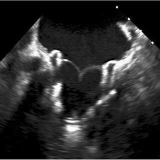 D Transesophageal Echocardiography Showing The Atrial Side Of A