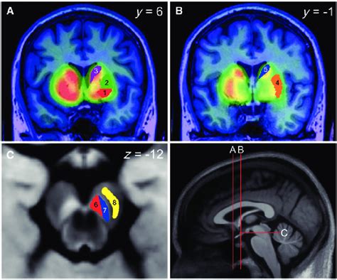 Substantia Nigra Parkinsons