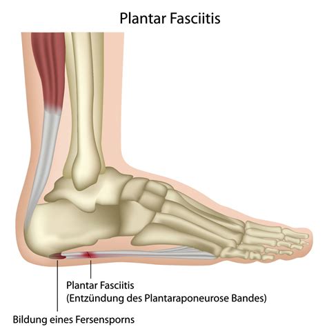 Halbfu Sohlen Bei Fersensporn Apotheken Warentest Plantar Fasciitis