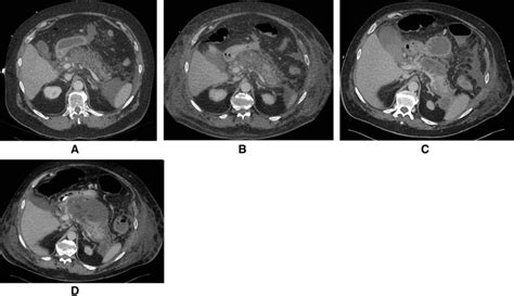 Evolving Necrotizing Pancreatitis With Acute Necrotic Collections Download Scientific Diagram