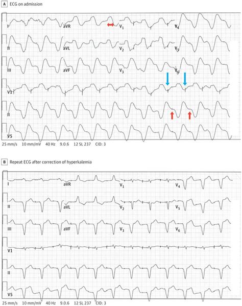 wide wide qrs jama internal medicine