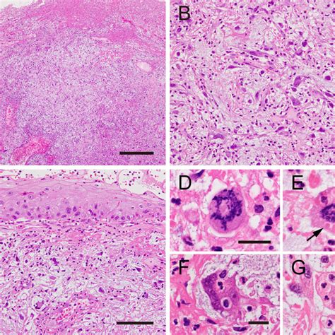 Histopathological Findings Of The Biopsy Specimen A The Polypoid Mass Download Scientific