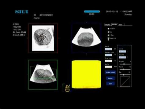 SIUI Apogee 1200 Color Doppler Ultrasound User Training Kullanıcı