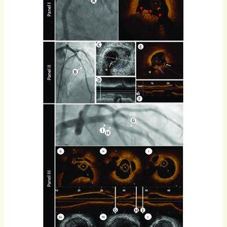 The Role Of Intravascular Imaging In Delineating Thrombus Panel I An