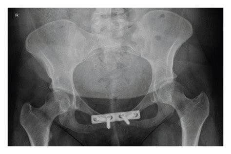 X Ray Of The Pelvis With A Pubic Symphysis Separation Is Shown In A Download Scientific