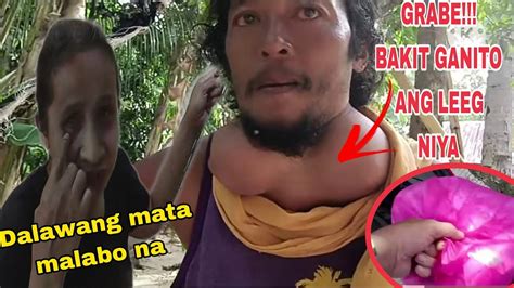 GRABE TATLO ANG BUKOL SA LEEG NI KUYA AT MALABO NA RIN PANINGIN NI