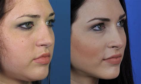 Related image | Nostril reduction, Reduction surgery, Reduction