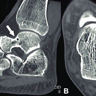 Imagen Centellograma oseo con hipercaptación en cuello del astragalo