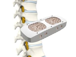 Minimally Invasive Lateral Lumbar Fusion Xlif Reston Va Spine