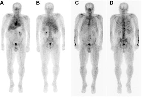 Tc 99m Hmdp Bone Scintigraphy For Cardiac Amyloidosis Diagnosis A