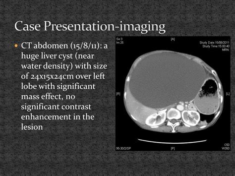 Ppt Management Of Hepatic Cysts Powerpoint Presentation Free Download Id1472205