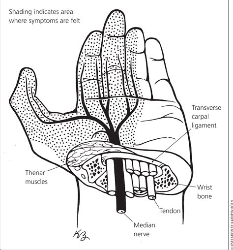 Carpal Tunnel Syndrome Aafp